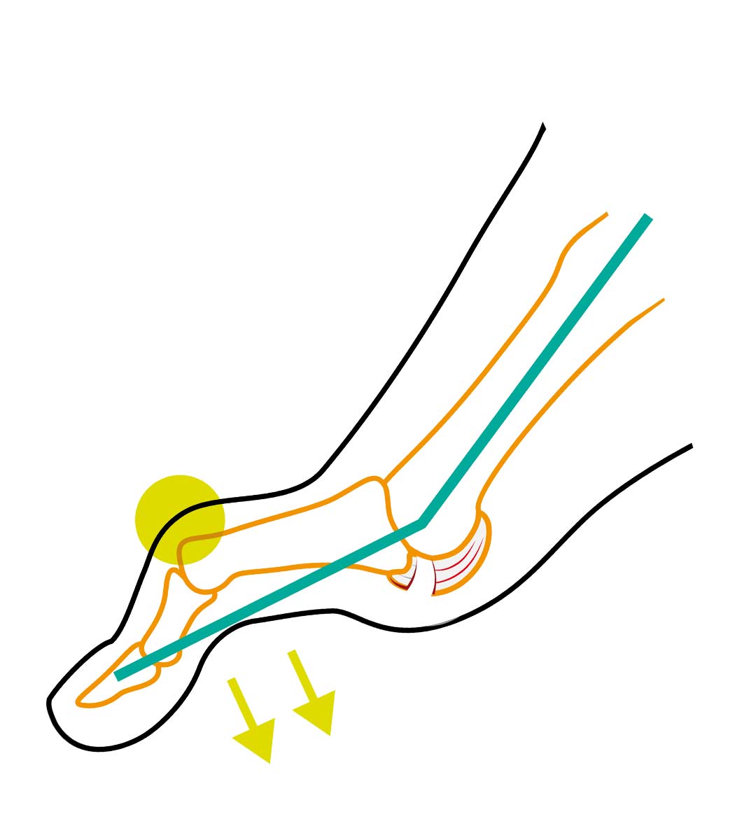 Corrective sock hammer toe TAPE SOX
